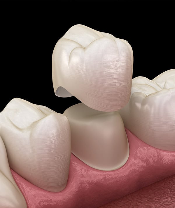 Dental professionals are examining a patient's tooth for an upcoming procedure for dental crowns.